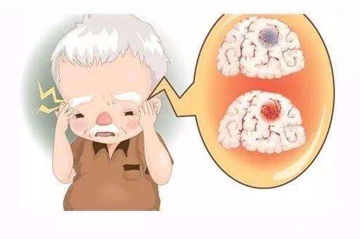 择思达斯经颅磁正规吗_脑梗塞会引起什么病症