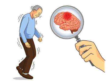 什么是经颅磁?帕金森怎么预防有什么方法