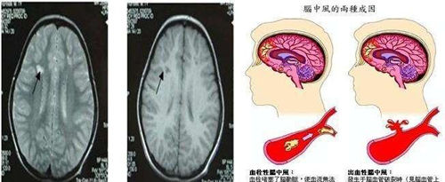 择思达斯经颅磁正规吗_导致脑血栓复发的几种原因